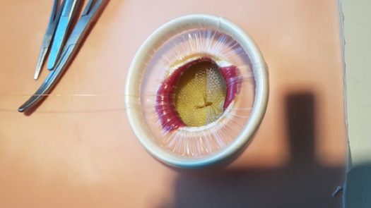 Stoma close up