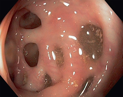 Photo of colon