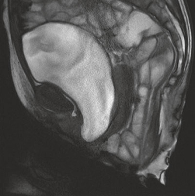 MRI showing a large sigmoidocele