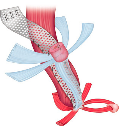 Illustration of ventral mesh recto(colpo)pexy