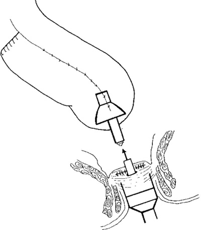 Diagram showing stapled ileal pouch-anal anastomosis