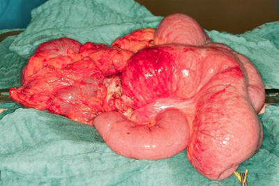 Photo of Ileocolic fistula in Crohn’s disease of the ileocecal region