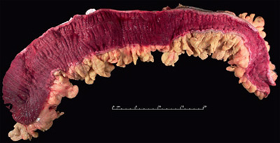 Image showing severe acute colitis