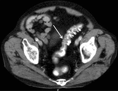 CT-scan image showing uncomplicated diverticulitis