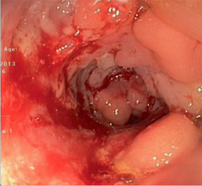 Photo showing colitis
