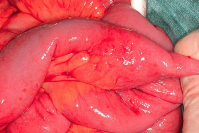 Photo showing 'fat creeping'  phenomenon in the small bowel in a patient with Crohn’s disease