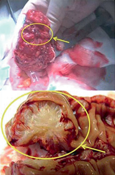 Photo showing endometriotic nodule infiltrating the intestinal wall