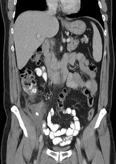 CT-scan image showing a calcified fecolith at the center of an inflamed appendix mass