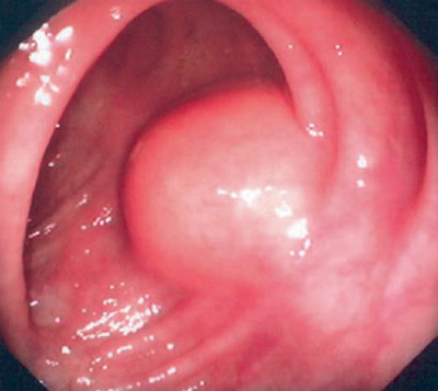 Photo showing lipoma of the colon