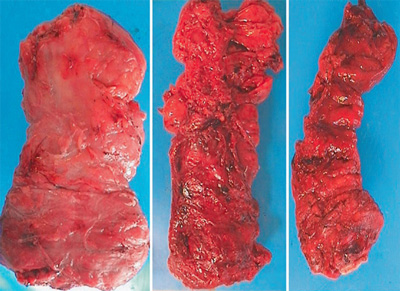 Photo showing surgical excision planes of three rectal cancer specimens
