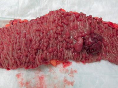 Photo of adenomatous polyps of the colon