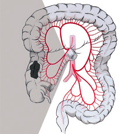 Diagram showing right-sided hemicolectomy with central ligation of the ileocolic artery and the right colonic artery