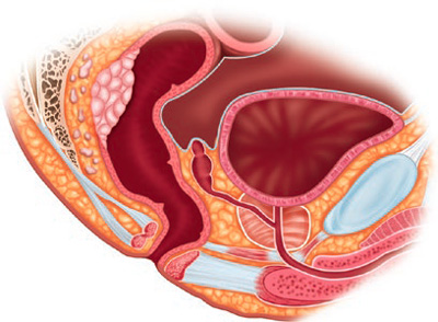 Illustration showing rectal cancer