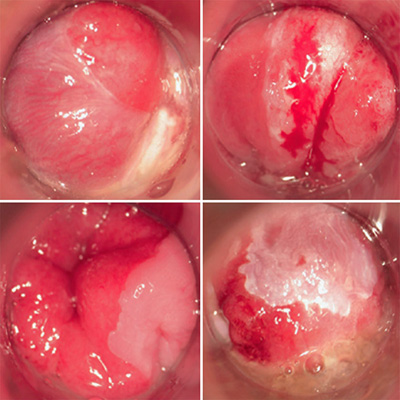 High-resolution anoscopy showing endoanal dysplasia