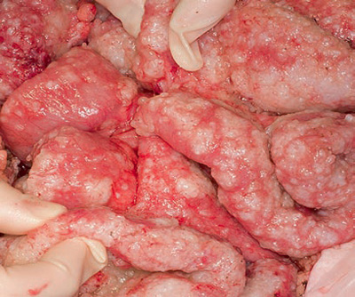 Photo showing colorectal peritoneal carcinomatosis