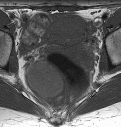 MRI scan image showing a tailgut cyst