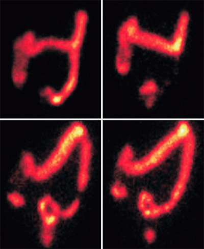 Scintigraphic image showing colorectal transit