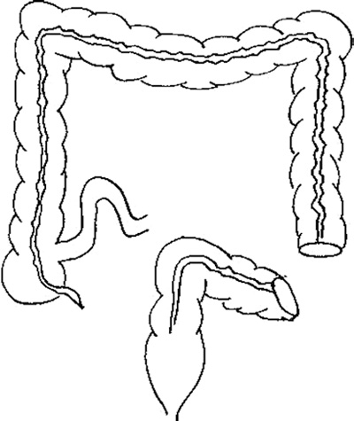 Diagram of a colostomy