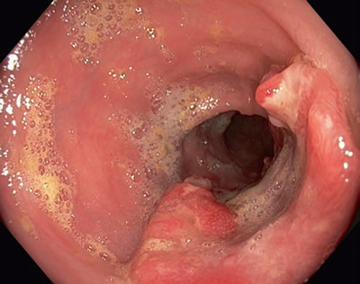 Endoscopic image showing a colon cancer