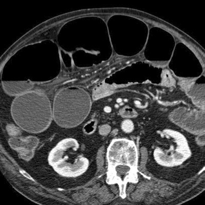 Image showing dilated bowels due to a large-bowel obstruction