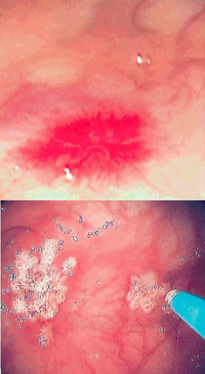 Photo showing colonic telangiectasia: endoscopic views before and after argon plasma therapy