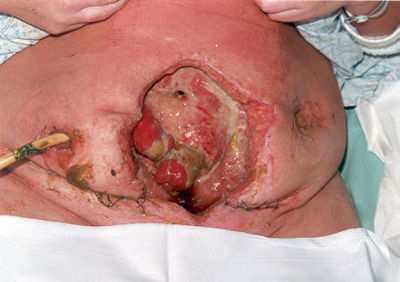 Photo showing severe abdominal sepsis associated with fistulation in the open abdomen