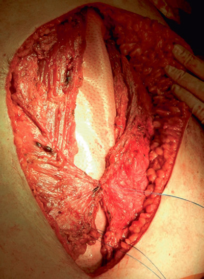 Photo showing placement of a biologic mesh during an open abdominal wall repair