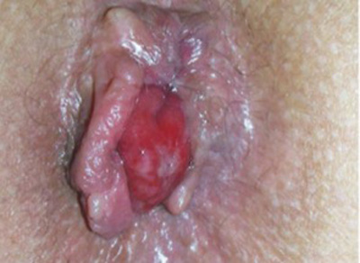 Photo showing hemorrhoidal prolapse