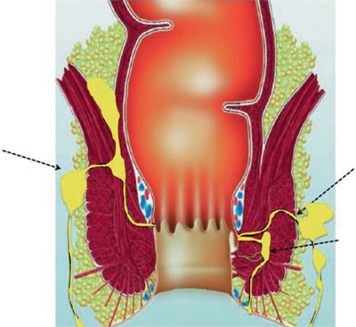 Illustration showing anorectal fistula
