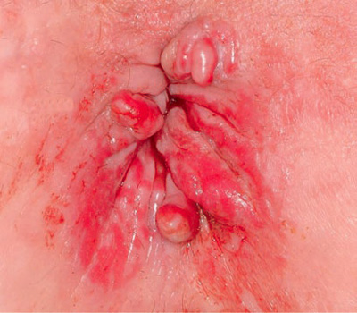 Photo showing anal inflammation and skin tags