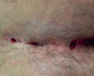 Photo showing pilonidal sinus disease with multiple midline pits