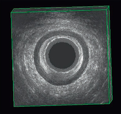 Endoanal ultrasound image showing internal and external sphincters