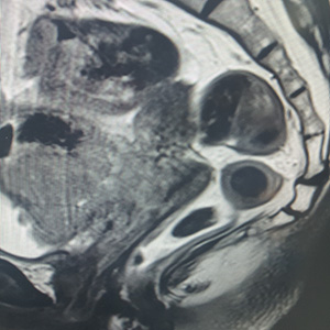 Image of a tumour that had lap pelvic exent after neoadjuvant therapy