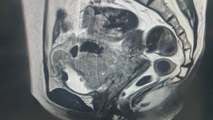 Image of a tumour that had lap pelvic exent after neoadjuvant therapy