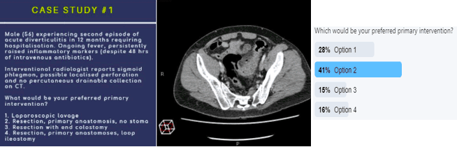 Diverticulitis case study Twitter poll info graphic