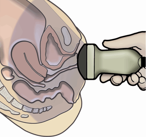 2D-Transperineal ultrasound schematic drawing