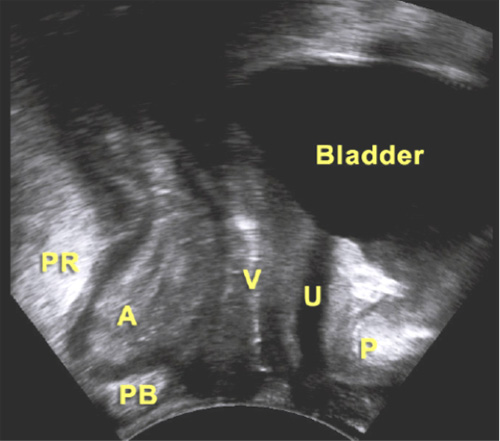 2D-Transperineal ultrasound image - pelvic organs at rest