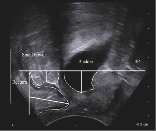 2D-Transperineal ultrasound image - Pelvic organs descent below the symphysis pubis line after Valsalva manouver