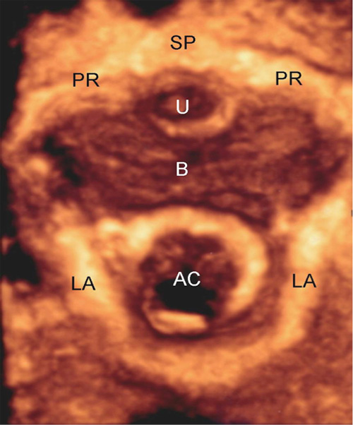 3D-Transperineal ultrasound axial image of the pelvic floor at rest