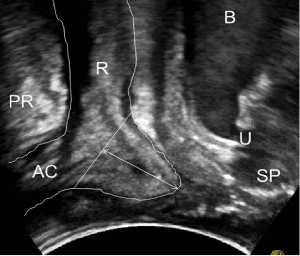 2D-Transperineal ultrasound midsagittal image of the pelvic floor during Valsalva showing an anterior rectocele (bulging of the anterior rectal wall)