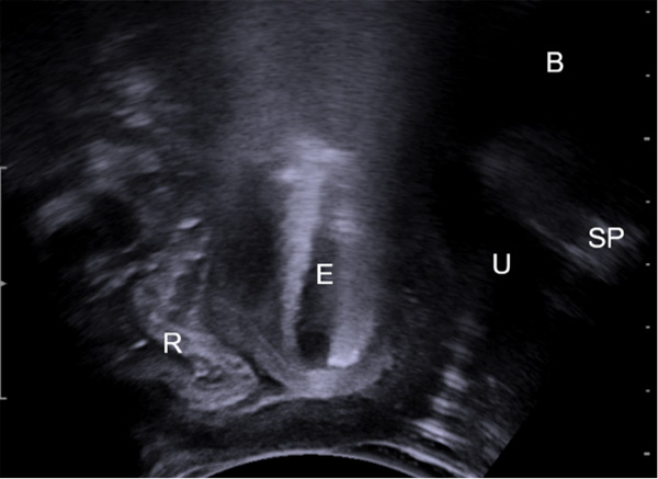 2D-Transperineal ultrasound midsagittal image of the pelvic floor during Valsalva showing an enterocele